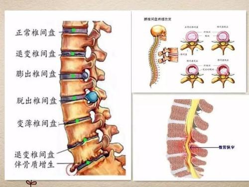 强直性脊柱炎针灸疗法