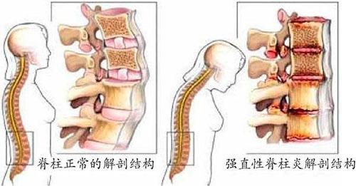 强直性脊柱炎分阴性阳性