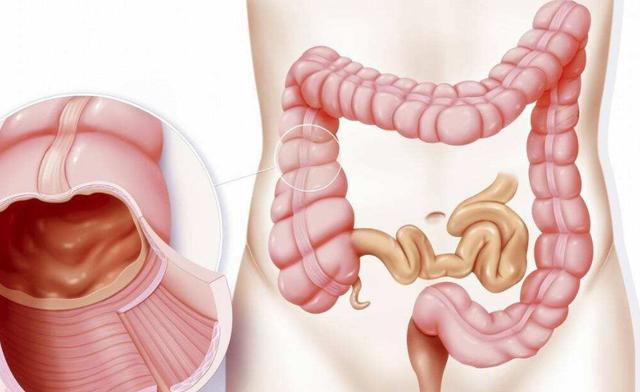 里急后重一定是溃疡性结肠炎吗