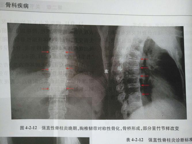 强直性脊柱炎和脊柱韧带炎的区别