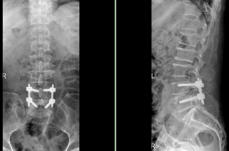 强直性脊柱炎患者第4根颈椎断掉