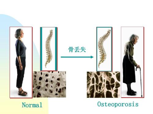 强直性脊柱炎和糖尿病哪个好