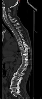 强直性脊柱炎胸椎骨折
