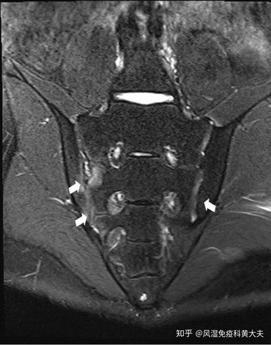 强直性脊柱炎骶髂关节ct