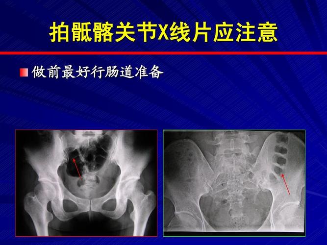 强直性脊柱炎发现太晚可以治疗吗