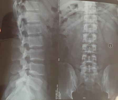 强直性脊柱炎浑身发冷无力