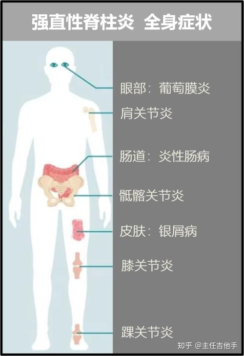 强直性脊柱炎下雨症状会加剧吗