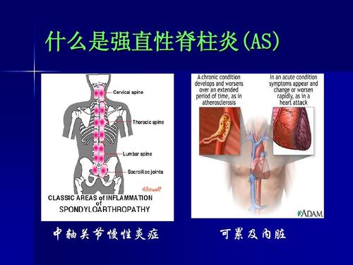 强直性脊柱炎预后