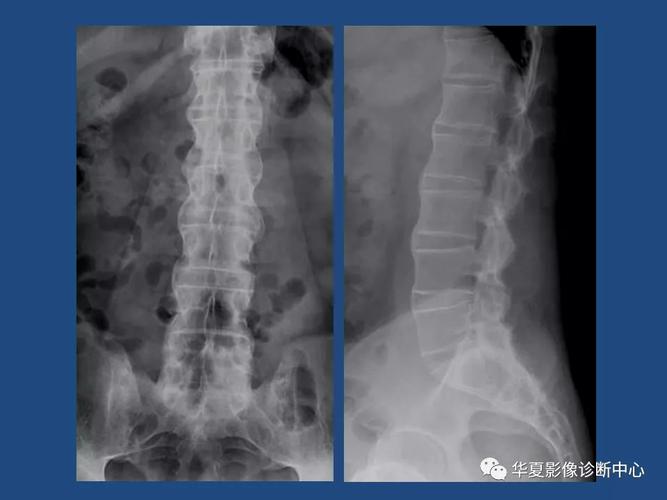 强直性脊柱炎治疗医院有哪些