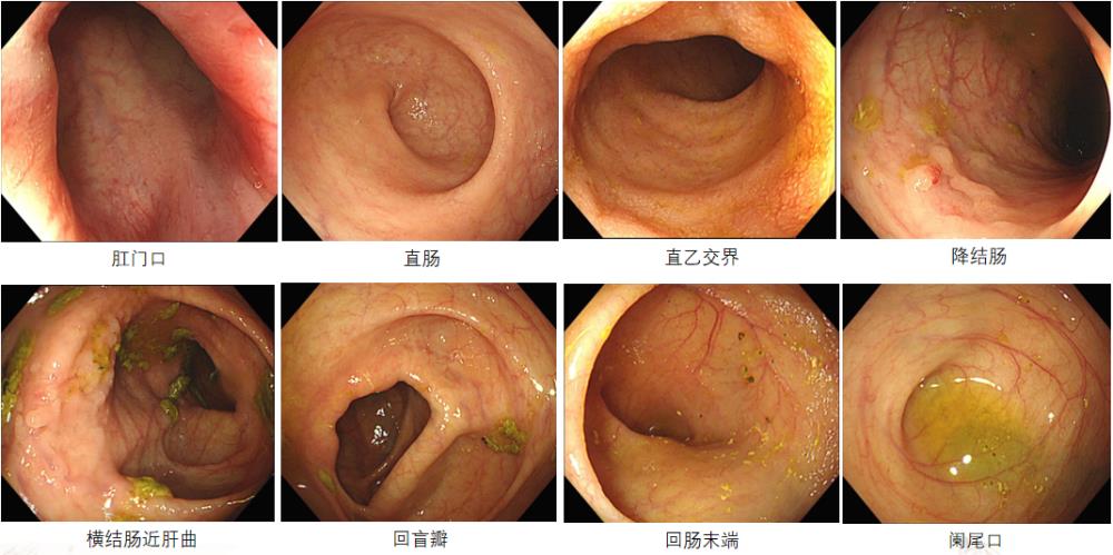 弥漫性溃疡性结肠炎看那个科