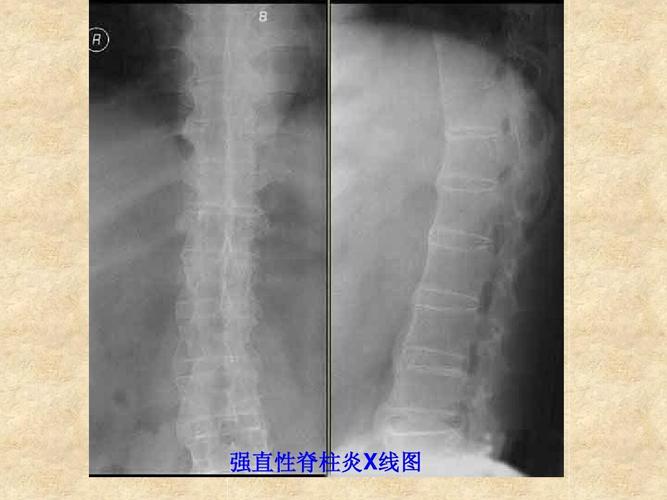 强直性脊柱炎磁共振影像图