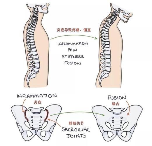 蛲虫感染导致强直性脊柱炎