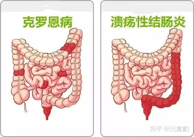 小儿溃疡性结肠炎中医治疗