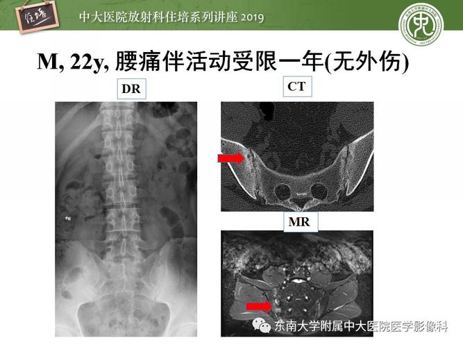 强直性脊柱炎影像学习