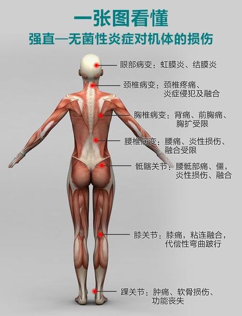 强直性脊柱炎预后效果