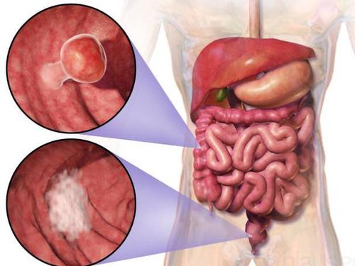 溃疡性结肠炎结肠腺瘤