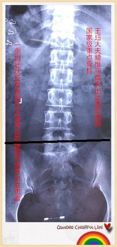 强直性脊柱炎椎间盘突出症