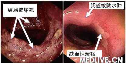 右侧溃疡性结肠炎最常见临床表现