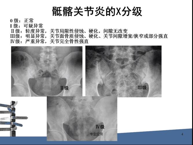 强直性脊柱炎引起臀部肌肉水肿