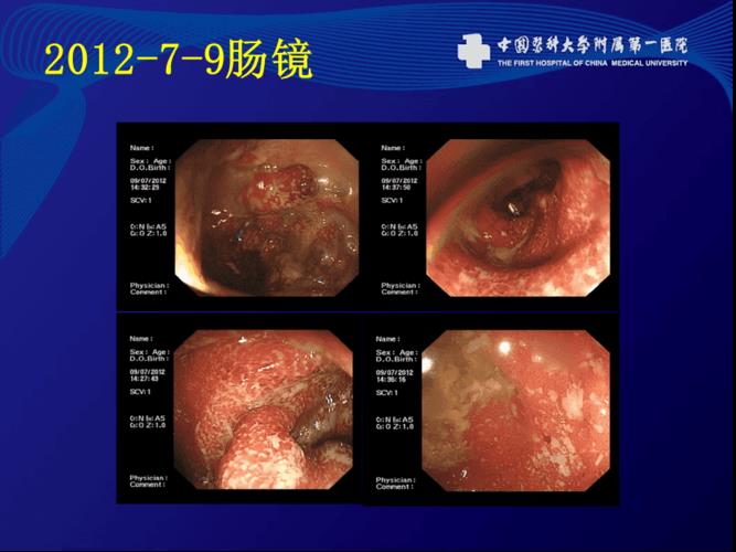 溃疡性结肠炎腹壁紧张