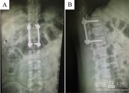 强直性脊柱炎早期现象