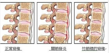 强直性脊柱炎