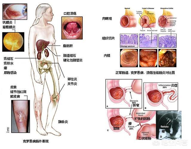 溃疡性结肠炎和克罗恩病的肠镜