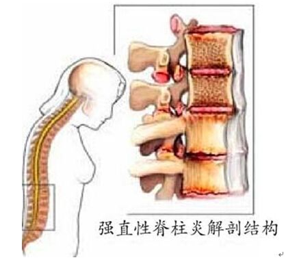 强直性脊柱炎和自身免疫性肝炎