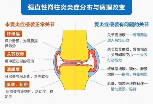 什么治强直性脊柱炎好