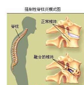 女性强直性脊柱炎吃药能缓解吗