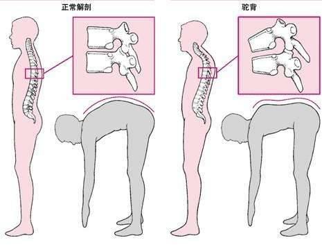 强直性脊柱炎40岁趋于稳定