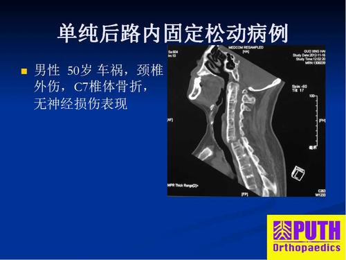 强直性脊柱炎颈椎修复