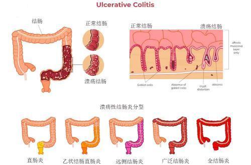 溃疡性结肠炎说法不正确