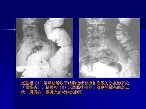 溃疡性结肠炎屁多怎办