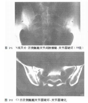 能误诊成强直性脊柱炎吗