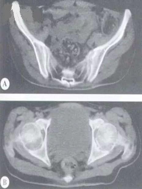 强直性脊柱炎阴道刺激