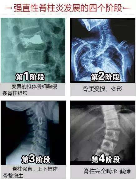 什么原因引发强直性脊柱炎