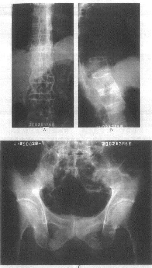 强直性脊柱炎中医病名竹节风