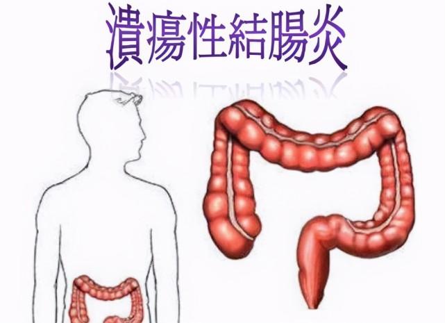 溃疡性结肠炎治疗后怎么治愈