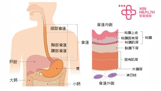 食道癌