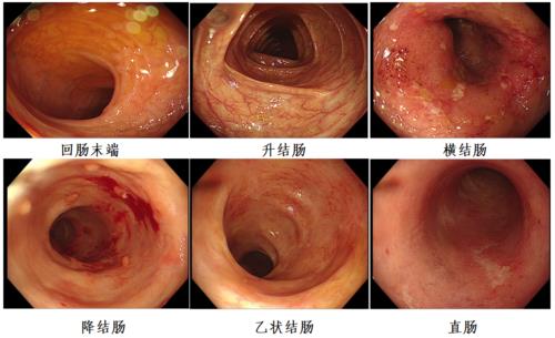 溃疡性结肠炎多久能检查肠镜