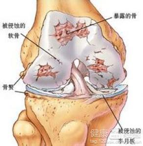 屁股两侧疼是强直性脊柱炎吗