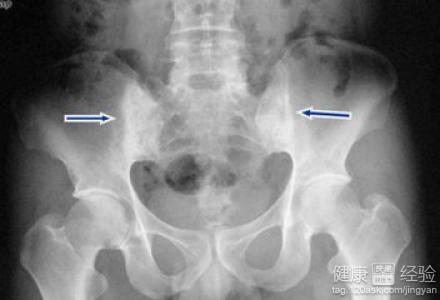 15岁强直性脊柱炎可以根治吗