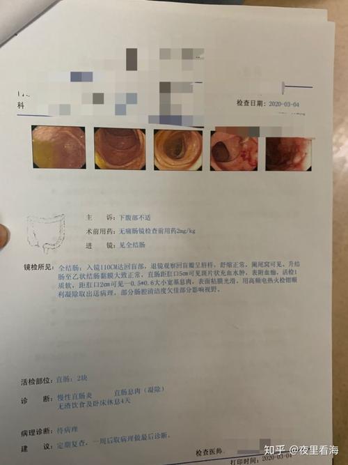 溃疡性结肠炎能按摩腹部吗