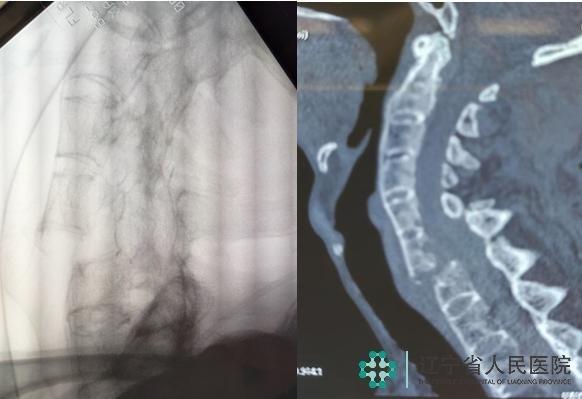 强直性脊柱炎颈部ct