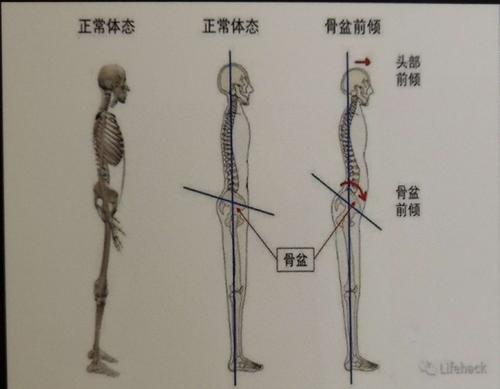 强直性脊柱炎髋骨变形