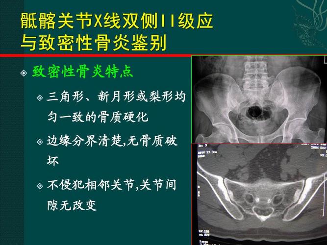 四平治疗强直性脊柱炎