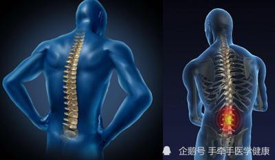 强直性脊柱炎其实不可怕