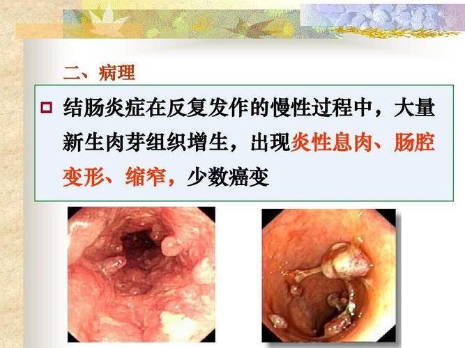 溃疡性结肠炎会引起尿蛋白增加吗