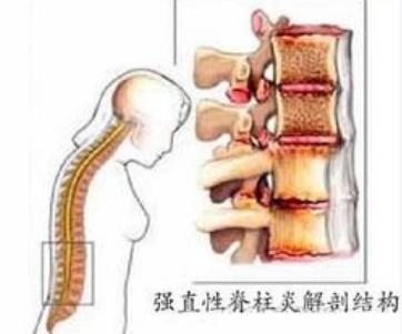 强直性脊柱炎中医用什么方治疗